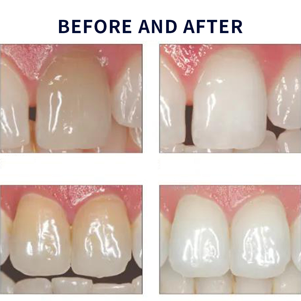 Opalescencia blanqueadora 20%  - Teeth Whitening Kit At Home reseña y precio