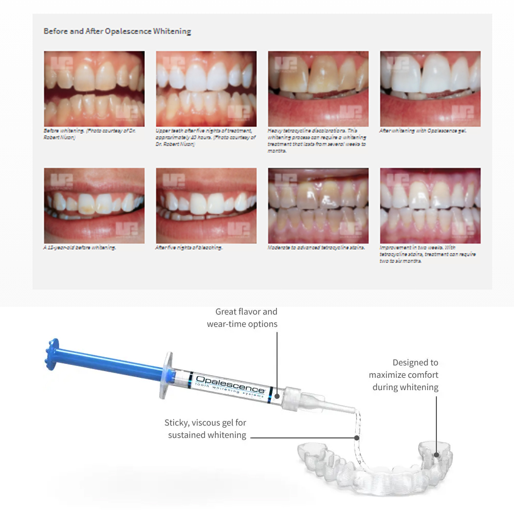 Opalescencia blanqueadora 20%  - Teeth Whitening Kit At Home reseña y precio