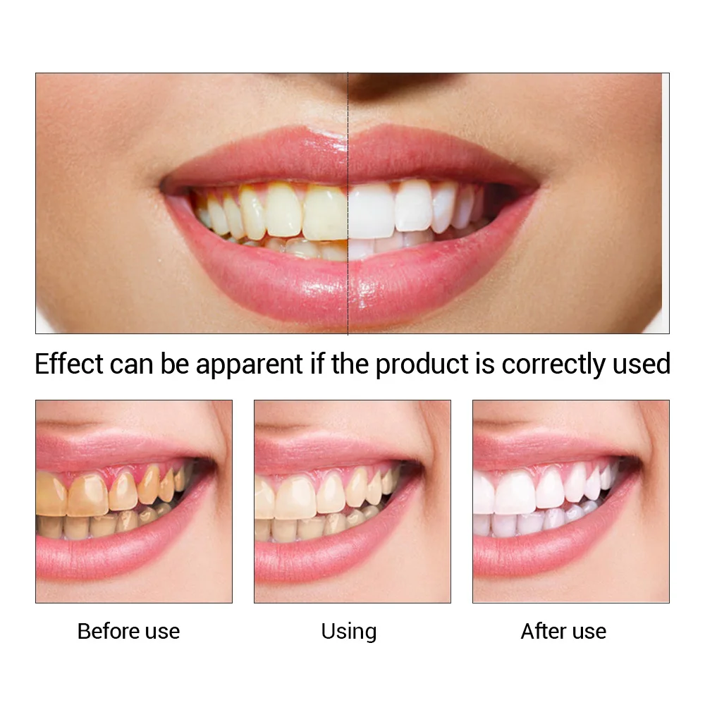 FTEENPLY-esencia para blanquea - Teeth Whitening Q&M reseña y precio