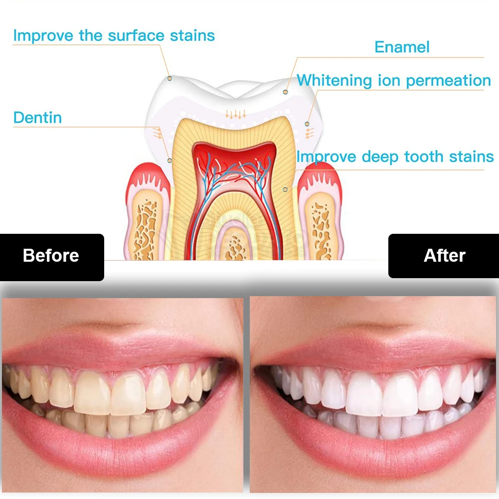 Kit de blanqueamiento Dental M - Teeth Whitening Pen reseña y precio